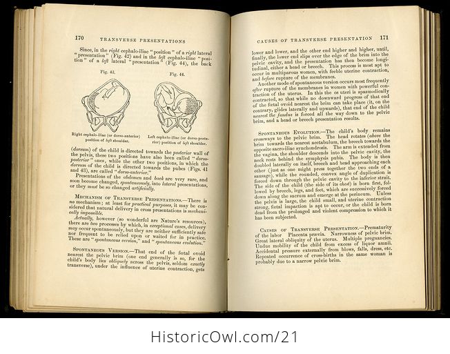 Kings Manual of Obstetrics Antique Illustration Book C 1884 - #FOL6lxEkGJs-5
